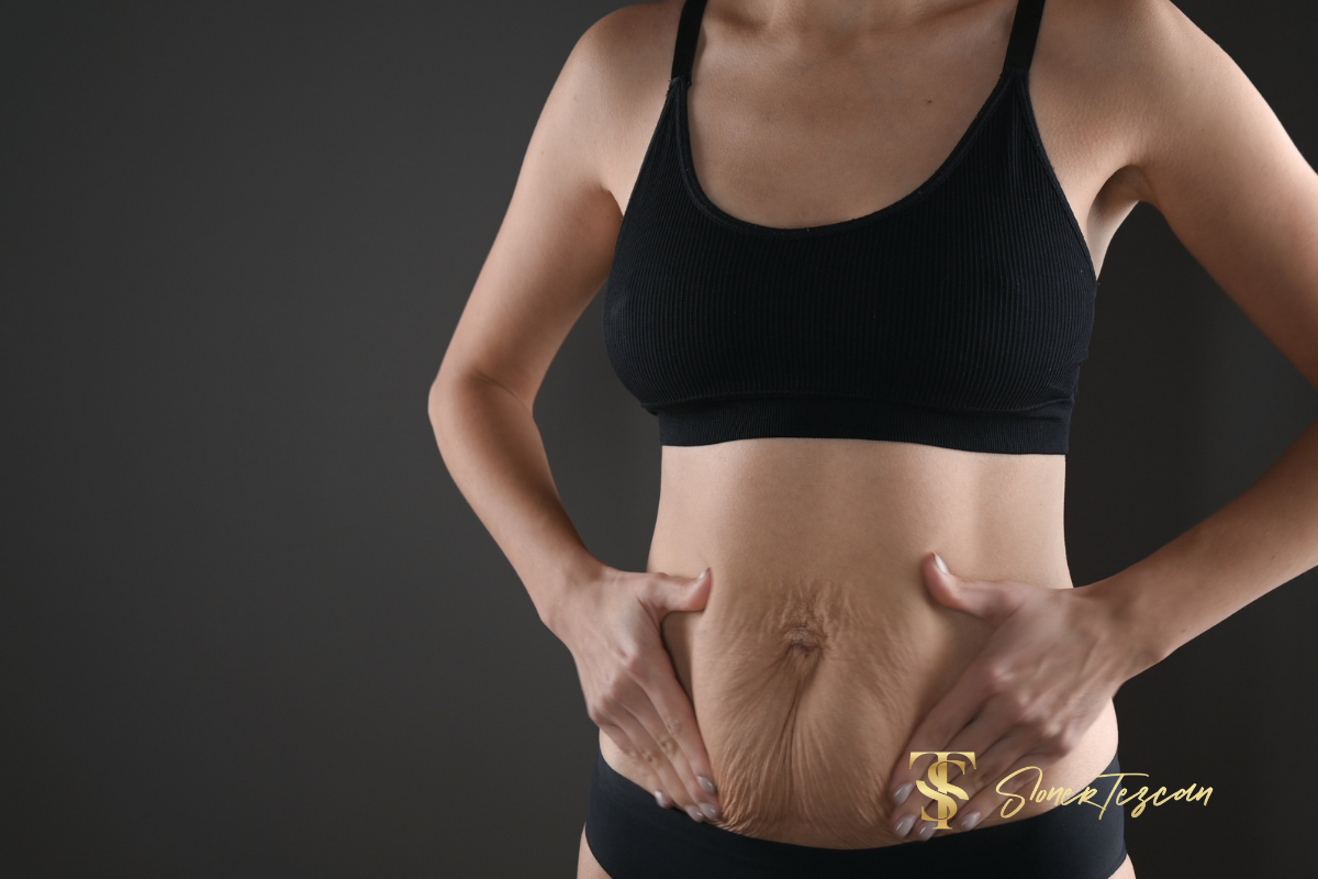 Lower Body Lift with Tummy Tuck: How to Correct the Waist, Hips, Buttocks and Abdominal Areas