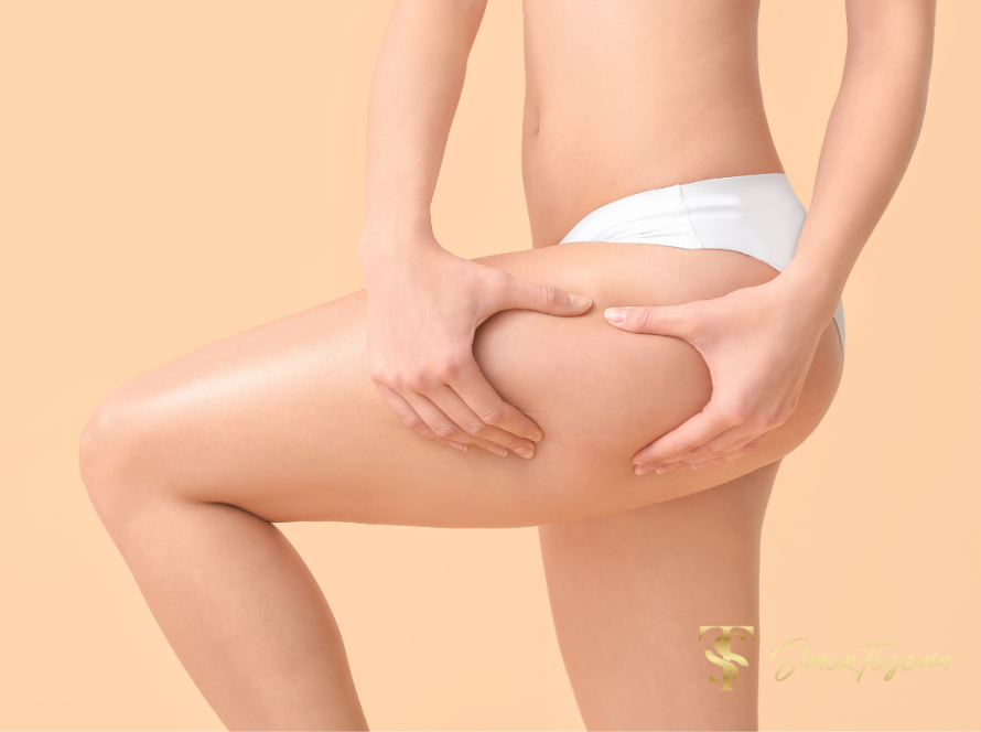 common treatments for cellulite