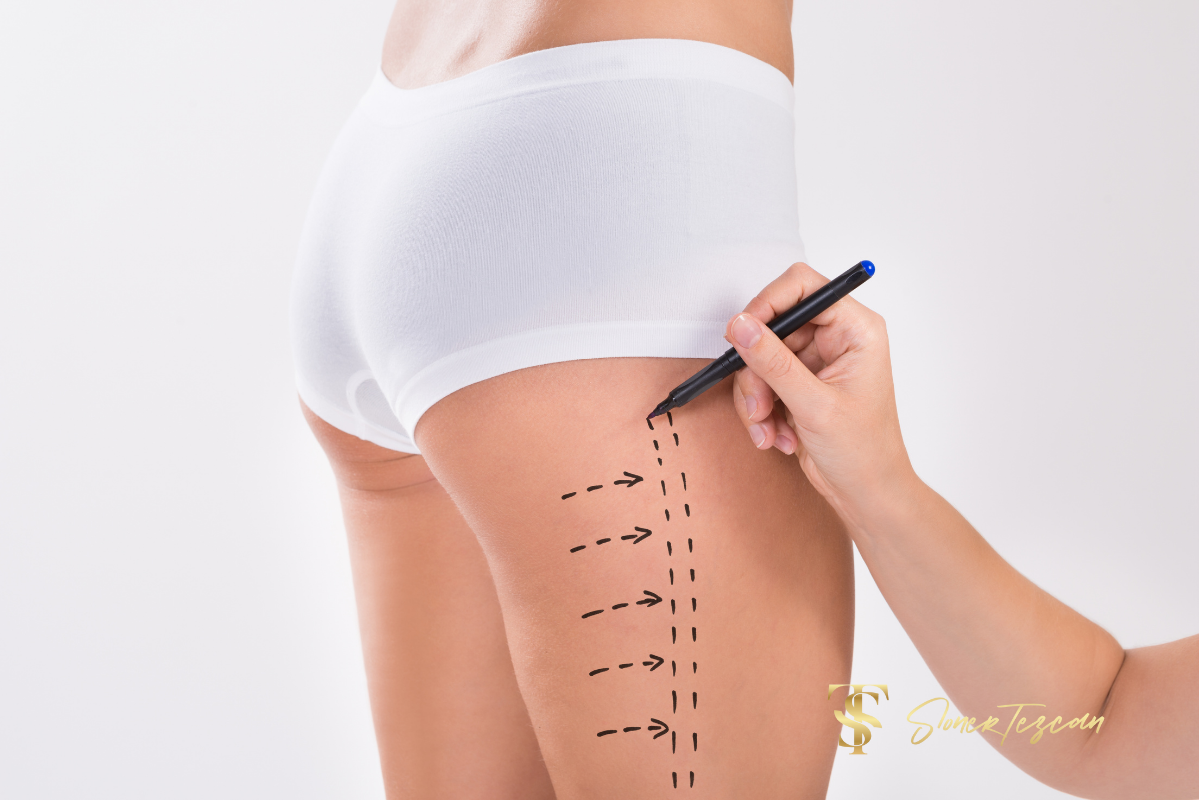 Liposuction ve Alt Vücut Germe Arasındaki Farklar Nelerdir?