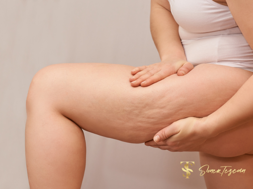 Leg Liposuction What You Should Know