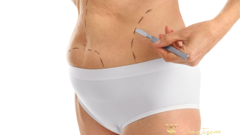 liposuction-fat-removal-aesthetics-1