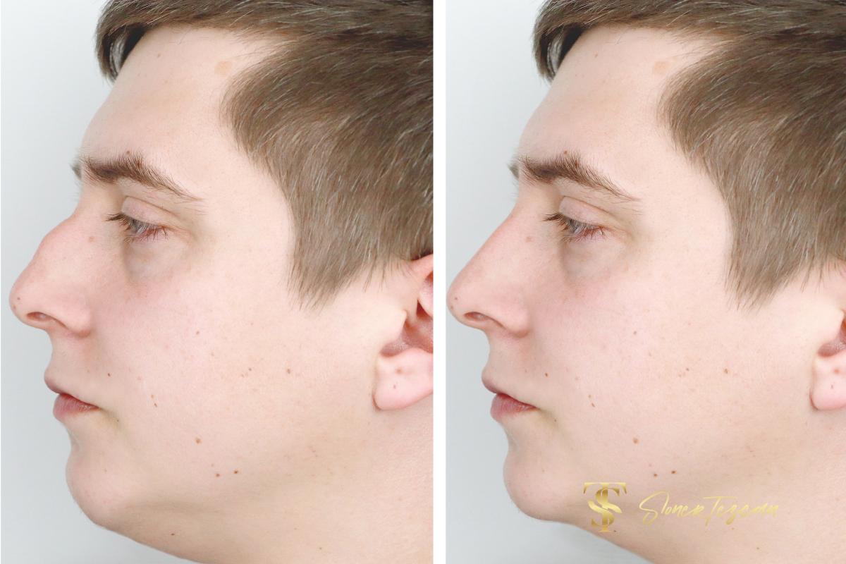 rhinoplasty-what-you-should-know-about-it