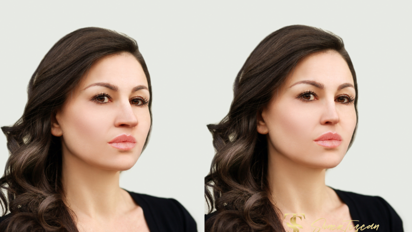 rhinoplasty-what-you-should-know-about-it