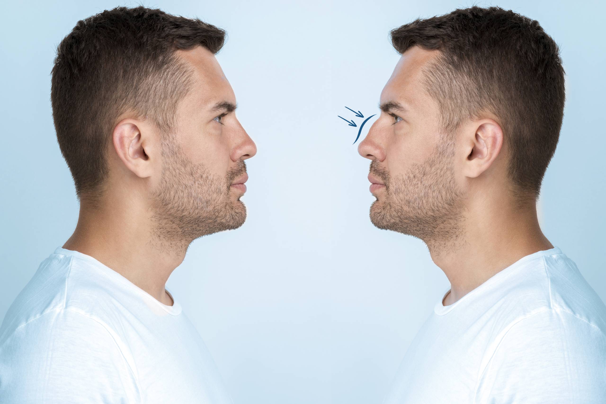 What is Nose Aesthetics for Men?